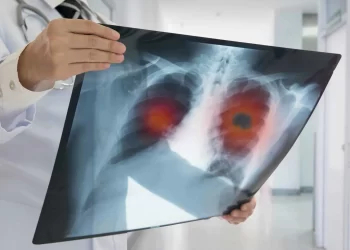 Câncer de pulmão é um dos mais incidentes no MA: oncologista destaca inovações no tratamento da doença