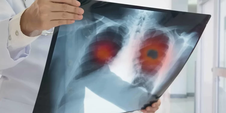 Câncer de pulmão é um dos mais incidentes no MA: oncologista destaca inovações no tratamento da doença